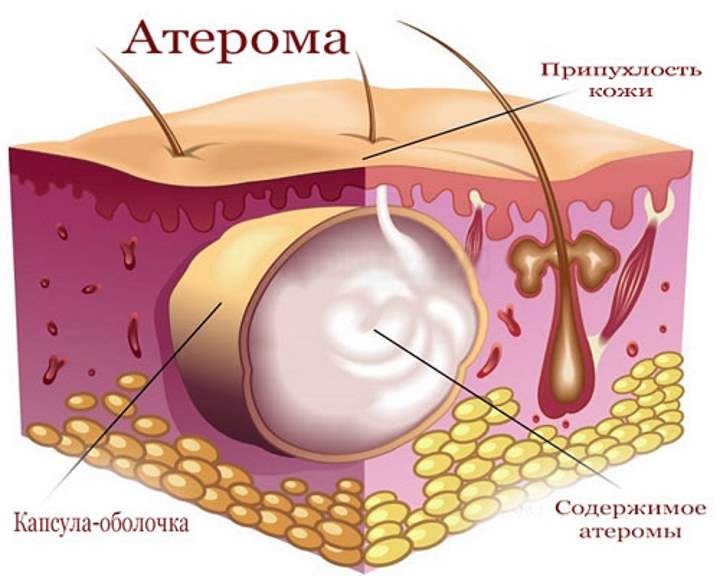 Атерома - визначення, причини появи, методи лікування