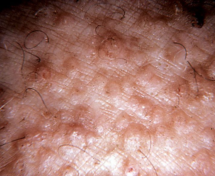 Лікування: амілоїдозу шкіри