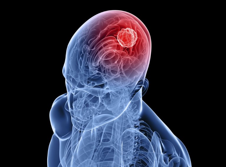Помірна зовнішня гідроцефалія головного мозку: причини, лікування
