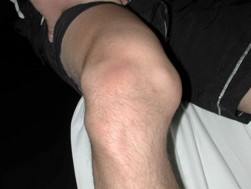 Вивих колінного суглоба: симптоми