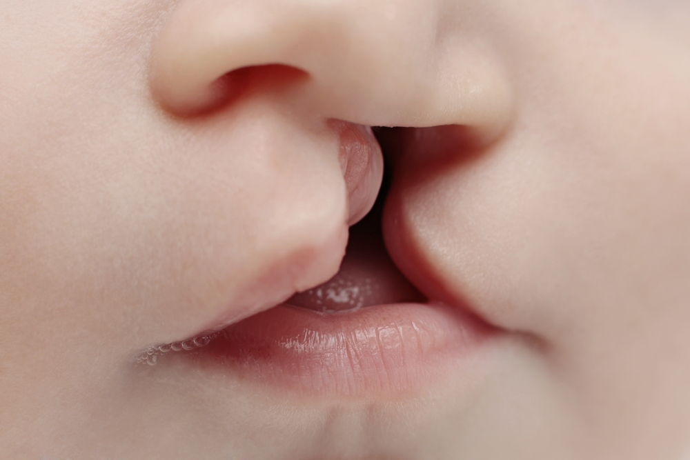 Заяча губа у дітей і дорослих: причини, симптоми