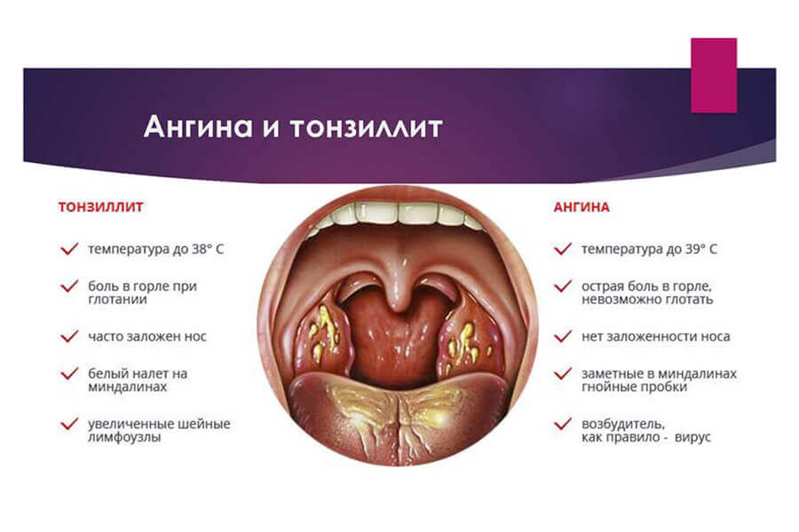 ангина как удалить гной